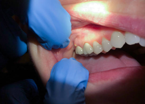 Best Dental Abscess Treatment in Fridley, MN