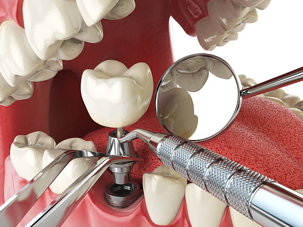 Best Emergency Root Canal Therapy in Fridley, MN